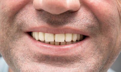 Obraz premium Real photograph of a man AFTER prosthetics of his upper teeth with telescopic dentures. A man in a doctor's office smiles with satisfaction and shows off his new teeth. Close-up.