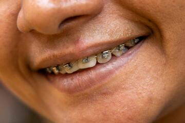 dental braces self-ligating smiling lips