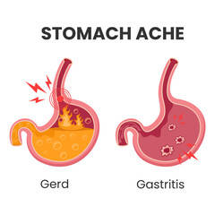 Vector illustration of stomachache with Gerd and Ulcer gastritis. suitable for gerd awareness week or Gastroesophageal Reflux Disease