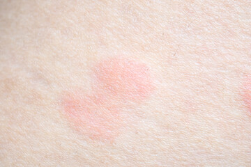 Skin allergy rash dermatitis texture close up