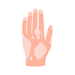 Vitiligo on skin of hand. Body with area pigmentation different color. Autoimmune disease. Vector