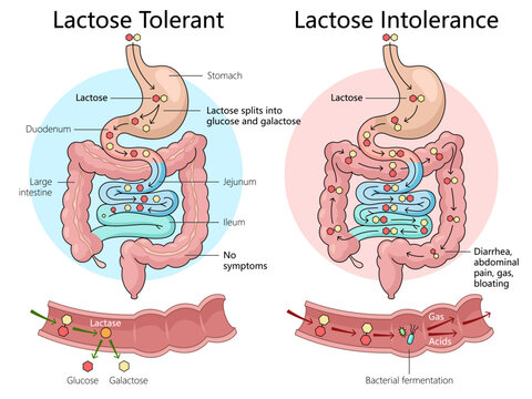 lactose tolerance and intolerance in the digestive system, illustrating symptoms and processes in intestines diagram hand drawn schematic vector illustration. Medical science educational illustration