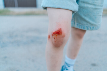 The child is wearing shorts and is standing on a light-colored surface. The image captures the raw...