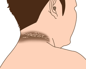 Diabetes man dark around neck skin, ilustration on whute background