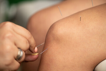 Acupuncture therapy  for reducing inflammation in the knee joint