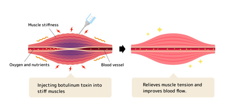 Mechanism of muscle relaxation by botulinum toxin injection