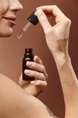 A young woman with vitiligo holds a dropper bottle of skincare product, applying it to her skin.