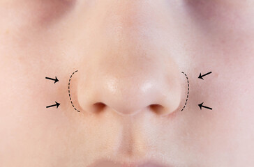 The nose of a child girl with black marks before surgical correction. Rhinoplasty of the nose in...