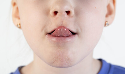 The girl shows her tongue out of her mouth. Concept of pathologies of the frenulum of the tongue,...