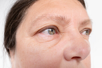 Puffy eyes of elderly Caucasian 55-year-old woman in close-up, swollen eyelids, medical issues and treatment options related to eye puffiness, health issues related to aging