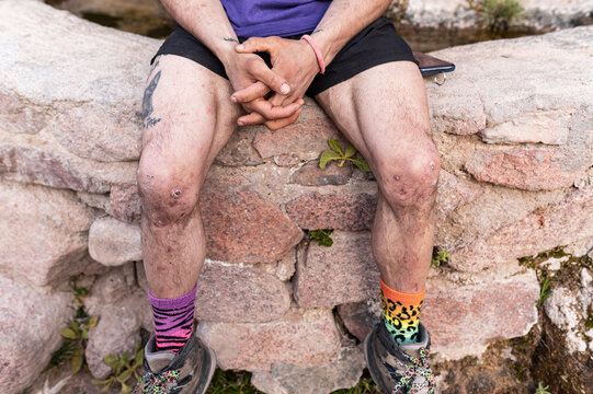 Hiker with bruised knees and hiking boots, real people
