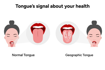 Geographic tongue problem and normal tongue © Oksana