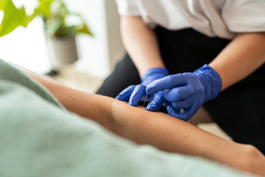 Physiotherapist treating with dry needling.