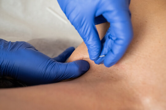 Dry needling.