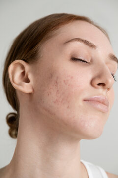 Portrait of Young Woman with Acne

