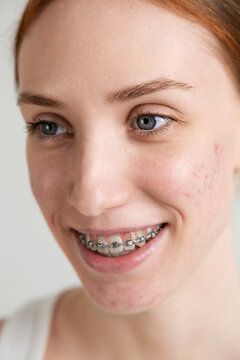 Smiling Young Woman with Acne and Braces