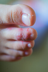 Blister on the skin on different part of the body