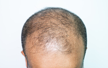 Close up of baldness men's scalp. Baldness is related to your genes and male sex hormones.