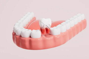 3d rendering tooth medical picture