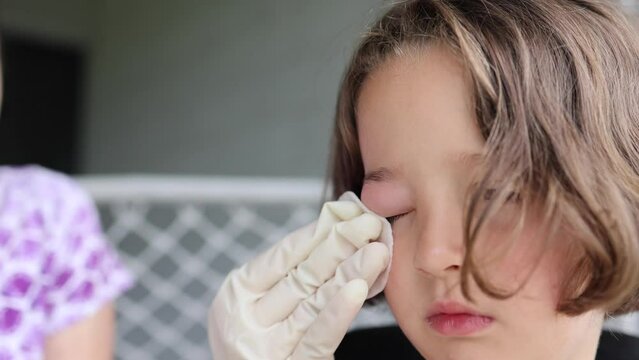 a small childhood infection on the eyelid caused by insect, mosquito or bee bites that causes swelling, redness, heat and itching. A mother is trying to remove swelling from a child's eye from an inse