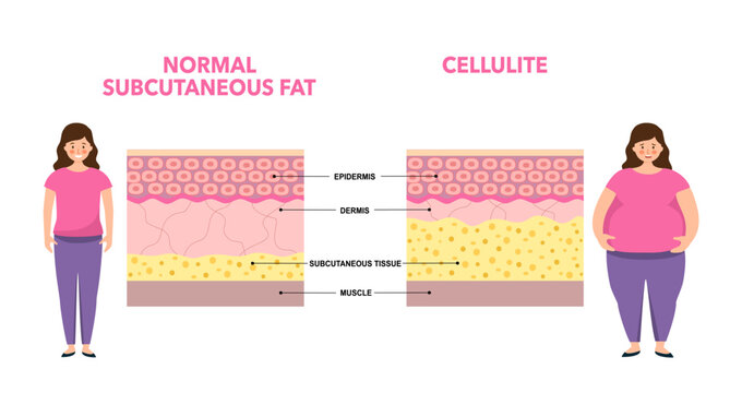 Cellulite concept, excess fat in human body. Overweight and increase subcutaneous fat diagram. Obese woman, diet program. Skin layers structure epidermis, dermis and hypodermis vector illustration.