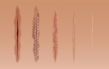 Set of healing wounds, skin scars, stitched gash and cuts. Realistic surgical sutures, stitched wounds at different healing stages isolated on human skin background