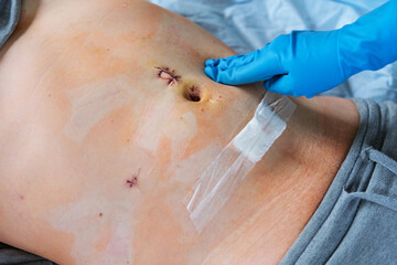 Hands of medic or nurse in blue gloves examining a fresh suture on a male stomach after laparoscopy...