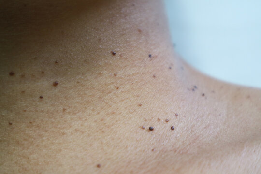 Close up the skin tags on woman's neck skin. Acrochordon. Skin tags are benign, non-cancerous tumors of the skin. usually harmless and painless. Health care concept.