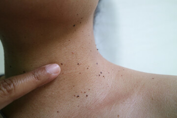 Close up the skin tags on woman's neck skin. Acrochordon. Skin tags are benign, non-cancerous tumors of the skin. usually harmless and painless. Health care concept.