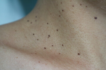 Close up the skin tags on woman's neck. Acrochordon. Health care concept. Woman showing her neck's...
