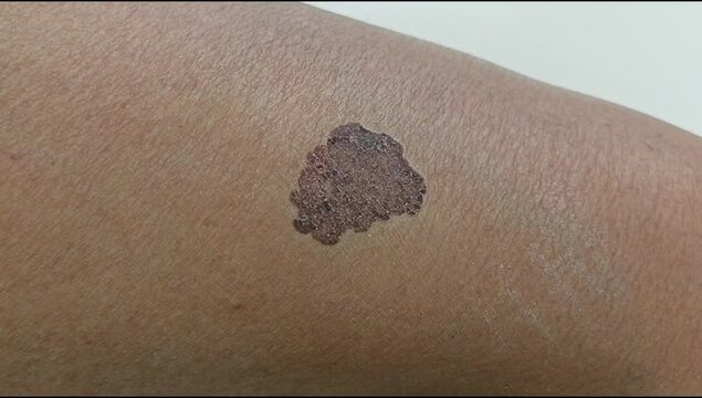 melanoma - a malignant tumor of the skin. A big mole on skin. Moving, and zoom in.