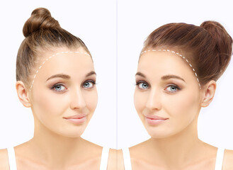 Thinning hair and hair loss,female pattern baldness,Hair transplant