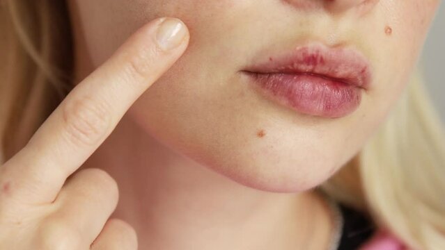 Woman checking her damaged lips with cold and herpes painful redness and bruising from rashes. Decreased immunity, allergy and illness.