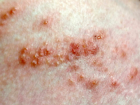 viral hepatitis, red blisters and rashes on the skin close-up
