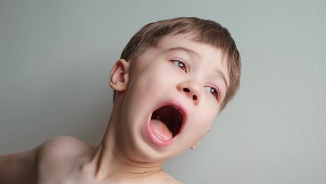 The boy yawning and stretching with a swollen eye from an insect bite and close-up view. Angioedema. Allergic response. Red inflamed upper eyelid. Disease or skin inflammation of child. Early morning