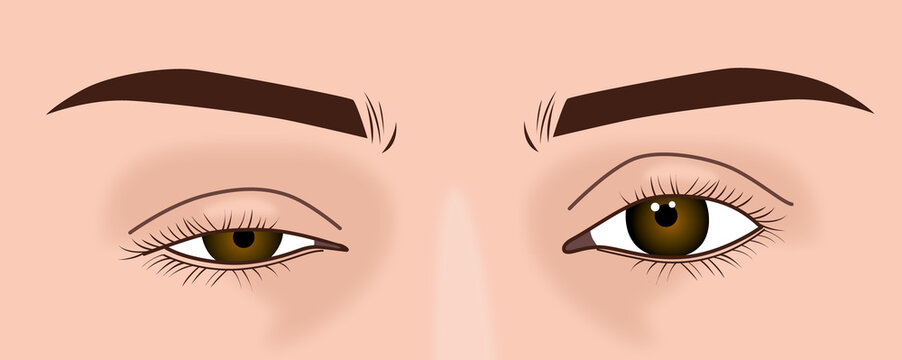 Droopy eyelid ptosis, blepharoplasty symptom, myasthenia gravis, illustration