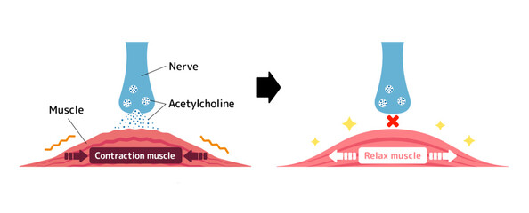 Mechanism of muscle relaxation by Botox. Vectror illustration.