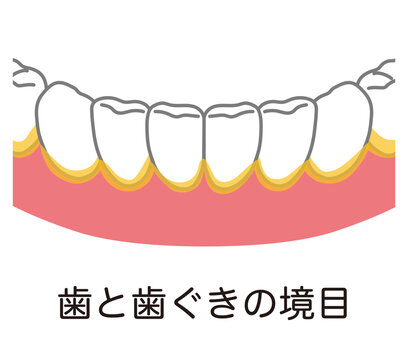 歯と歯ぐきの境目に溜まった歯垢　歯磨き　磨き残し