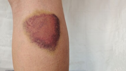 close up the bruises on the leg, illness and patient of the woman, health care and medical concept.