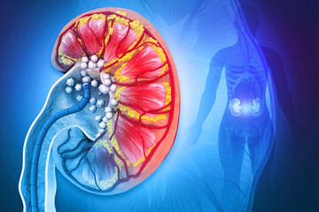 Remove kidney stones. 3d illustration