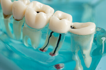 Dental implant, artificial tooth roots into jaw, root canal of dental treatment, gum disease, teeth...