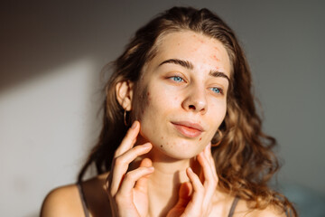 Obraz premium Woman with problem skin on her face. Medicine and cosmetology concept. Natural skin.