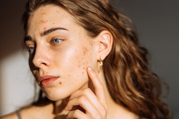 Woman with problem skin on her face. Medicine and cosmetology concept. Natural skin.