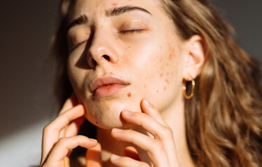 Woman with problem skin on her face. Medicine and cosmetology concept. Natural skin.