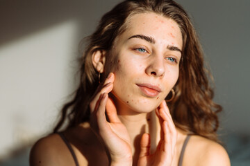 Obraz premium Woman with problem skin on her face. Medicine and cosmetology concept. Natural skin.