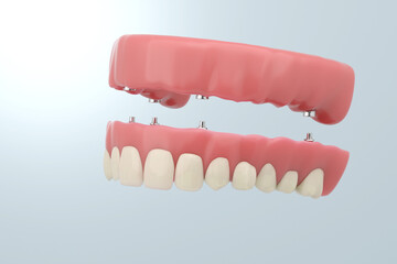 Full mouth dental implant supported denture. 3D rendering.