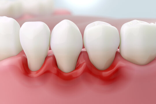 Gum disease and inflammation from Periodontitis. 3D rendering.