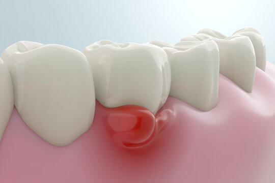 Gum disease or gum inflammation from gingivitis. 3D rendering.