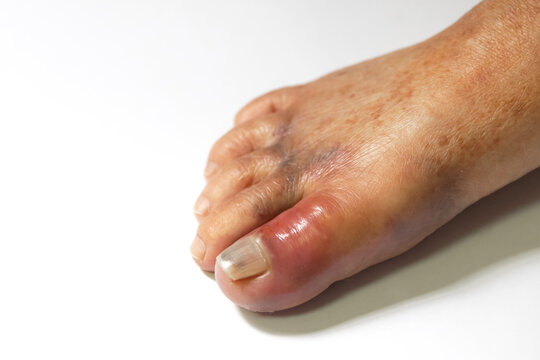 Swollen toe with gout inflammation. Gout is a form of inflammatory arthritis that occurs when uric acid crystals accumulate in the joints, causing severe pain, swelling, and redness.
