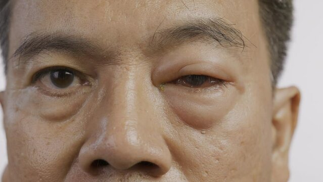 Senior man with swollen eye from insect bite on white background.
